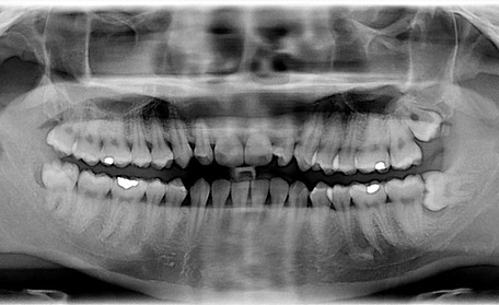 Extraction of Wisdom Teeth