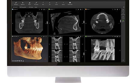 Cone Beam Tomography (KAVO OP 3D)