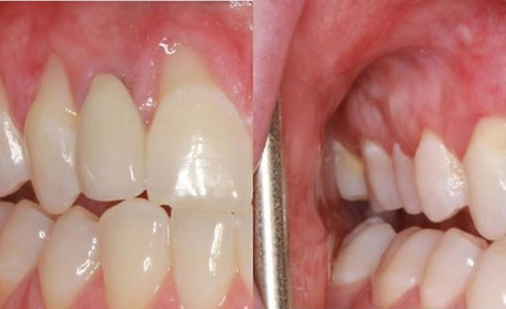 Gingival Regeneration