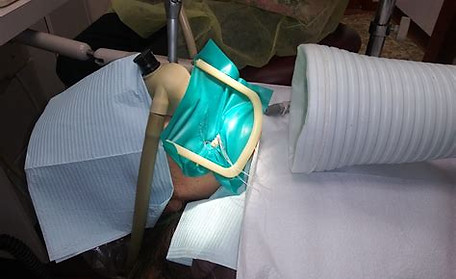 Safe Removal of Mercury Amalgams