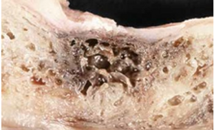 Bone Cavitation Treatment